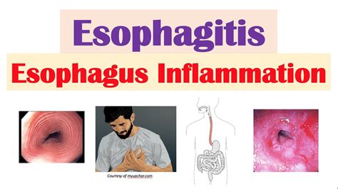 esophagus inflammation icd 10